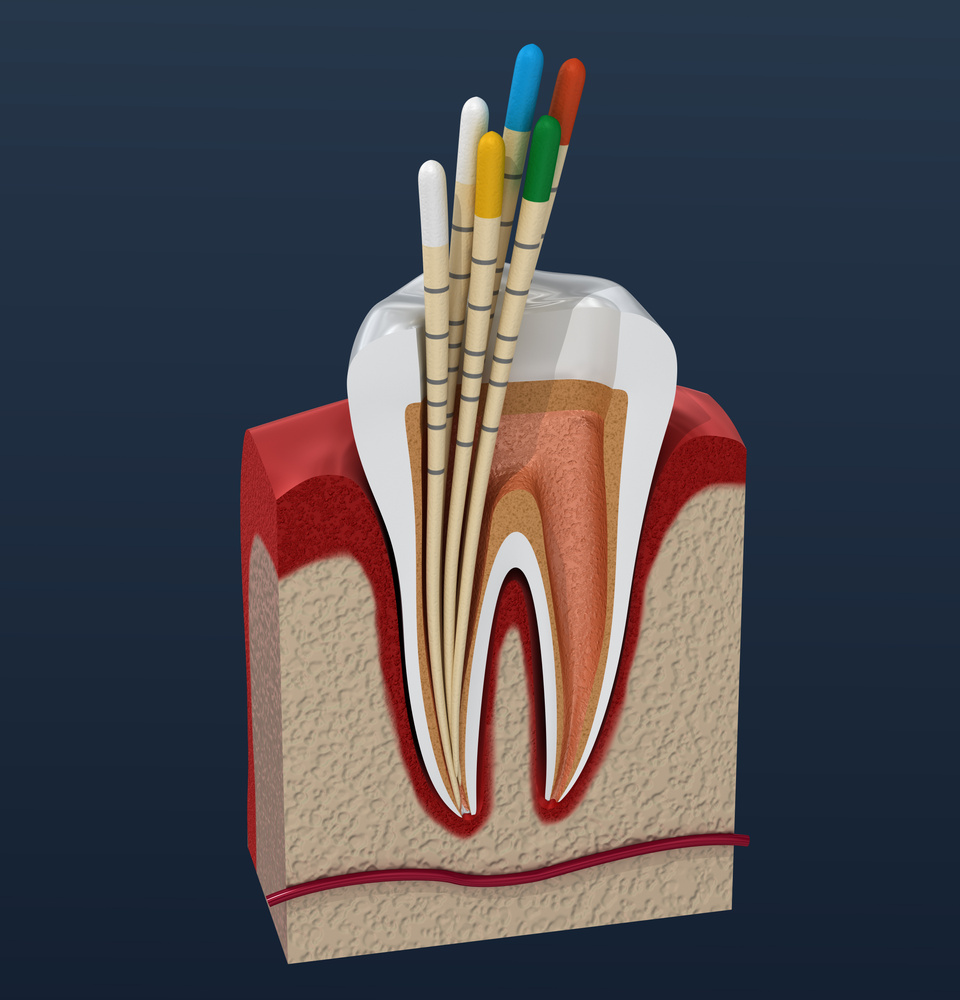 Gutta percha endodontics instrument, dental anatomy. 3D illustration