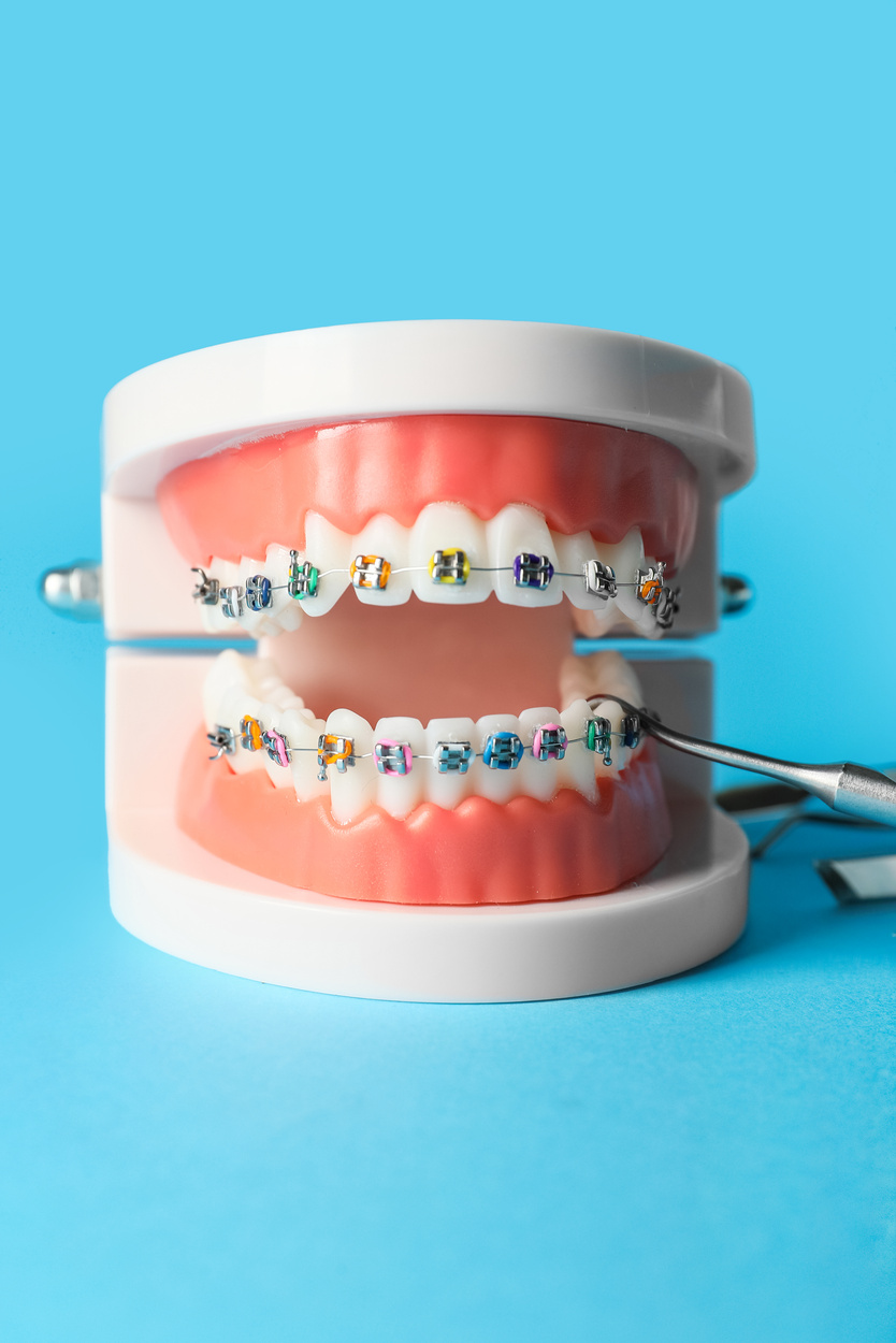 Model of Jaw with Braces and Dental Spatula on Blue Background